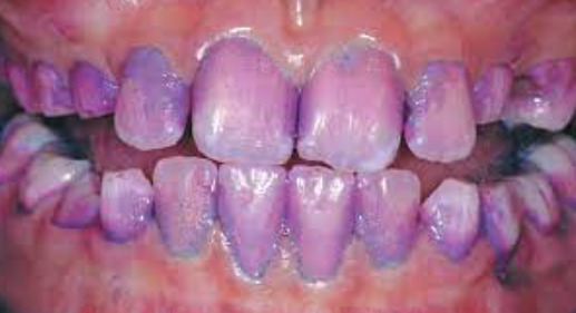 Purple Gums