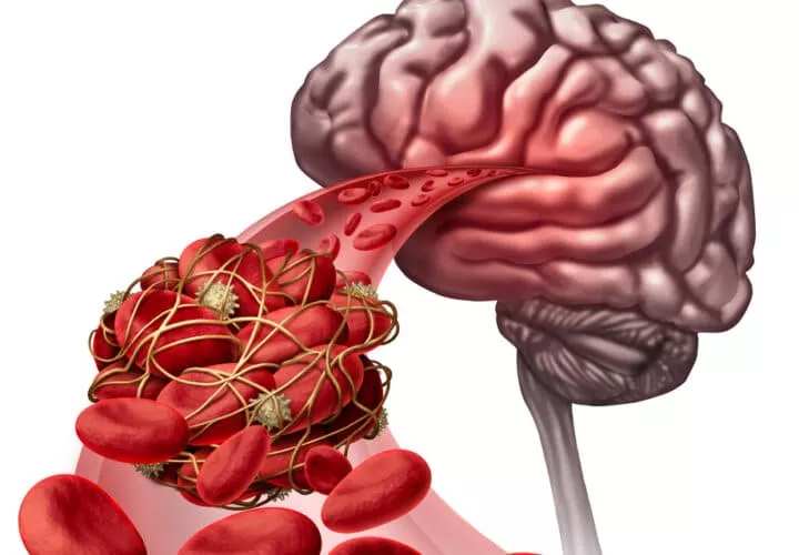 vascular dementia