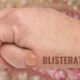 Blisterata: Everything You Need to Know
